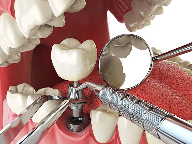 Best Knocked-Out Tooth (Avulsed Tooth) Treatment in Meggett, SC